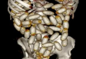 Le passeur avait ingéré 142 ovules: un record! DR 