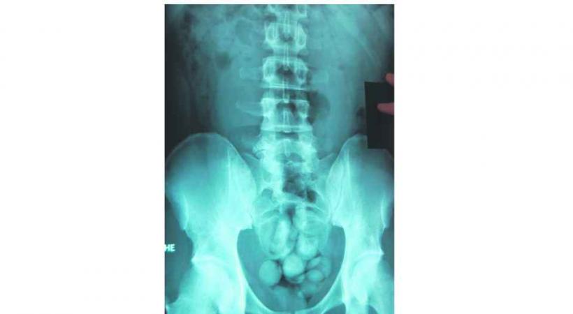 Les trafiquants ingèrent de plus en plus des bouletets de drogue. 
