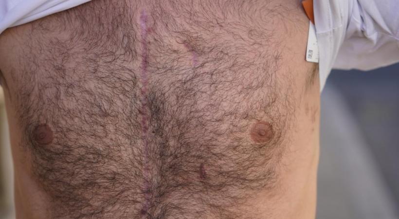 La victime montre ses terribles cicatrices. CHRISTIAN BONZON/DR