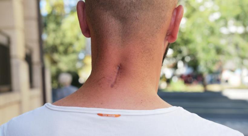 La victime montre ses terribles cicatrices. CHRISTIAN BONZON/DR